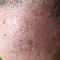 Actinic Keratoses