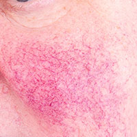 Rosacea